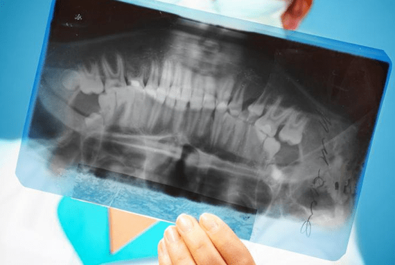 Рентген и диагностика зубов